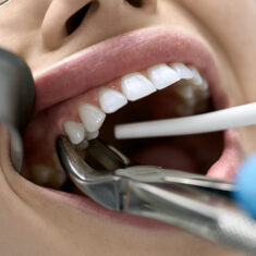 extração de dente