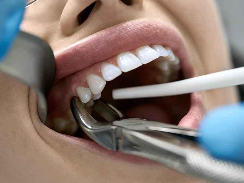 extração de dente