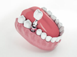 cirurgia oral