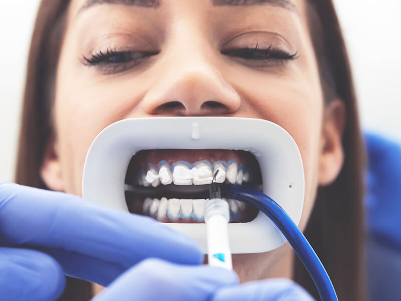 clareamento dental