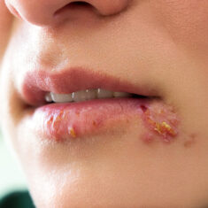 herpes