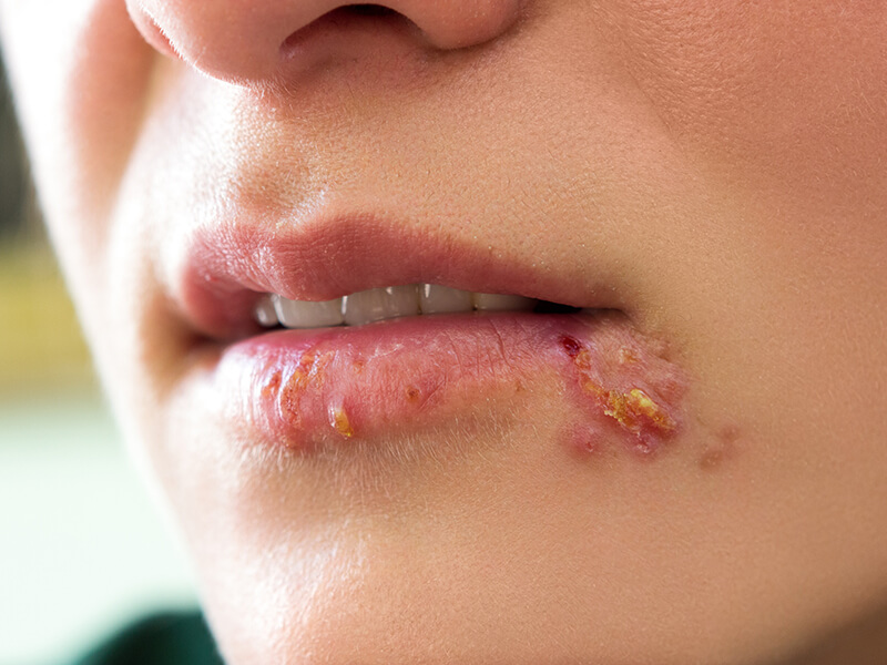 herpes