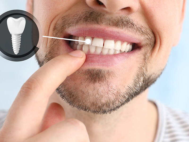 implantes dentários