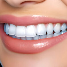 lentes de contato dental e facetas dentárias