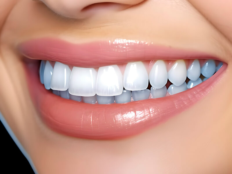 lentes de contato dental e facetas dentárias